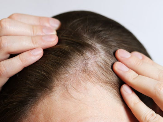 Common Nutrient Deficiencies That Can Cause Hair Loss